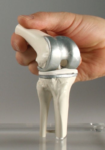 Knie-Implantat-Modell