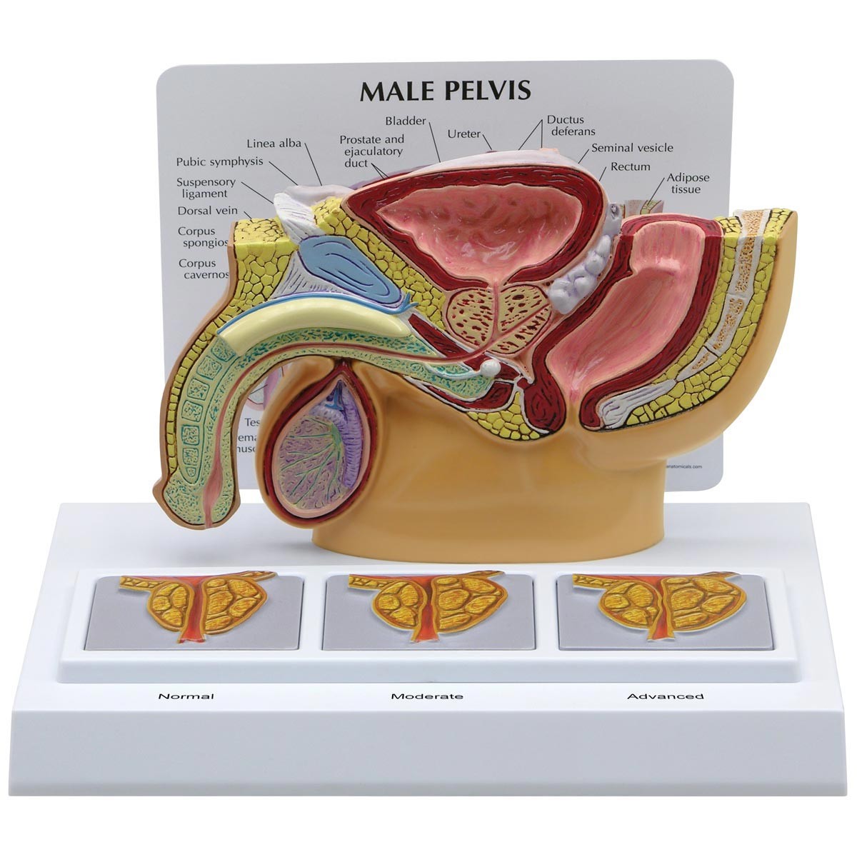 Männliches Becken mit 3D-Prostata-Rahmen