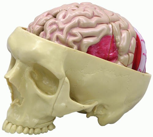 Schädelmodell mit Gehirnerkrankungen 