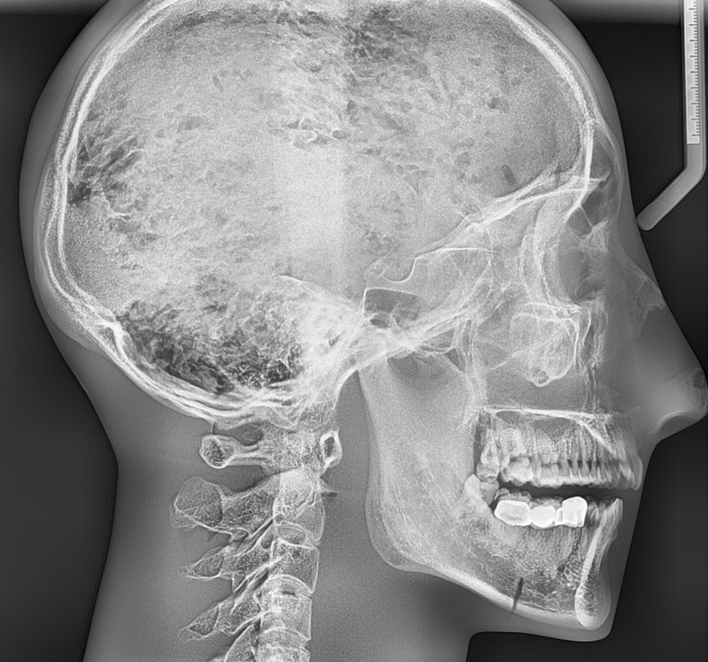 Röntgenphantom Kopf mit Halswirbeln, transparent 