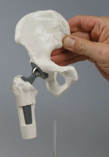 Hüft-Implantat-Modell