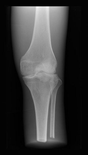 Röntgenphantom Knie, transparent