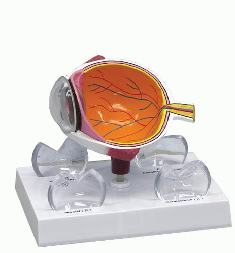 Augenmodell mit Hornhauterkrankungen