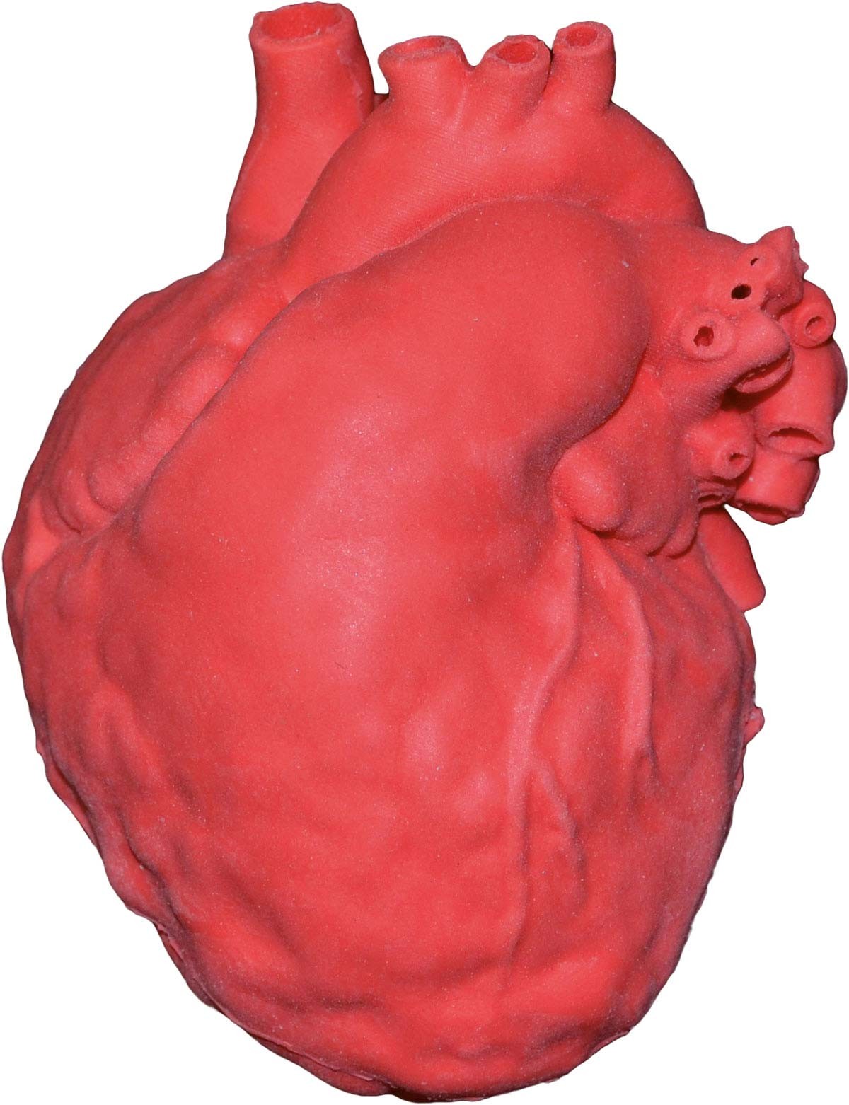 Pädiatrisches Herz mit Atriumseptumdefekt (ASD) 1