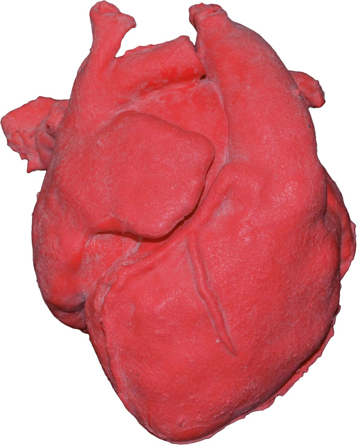 Pädiatrisches Herz mit korrigierter Transposition der großen Arterien (TGA) und Ventrikelseptumdef 1