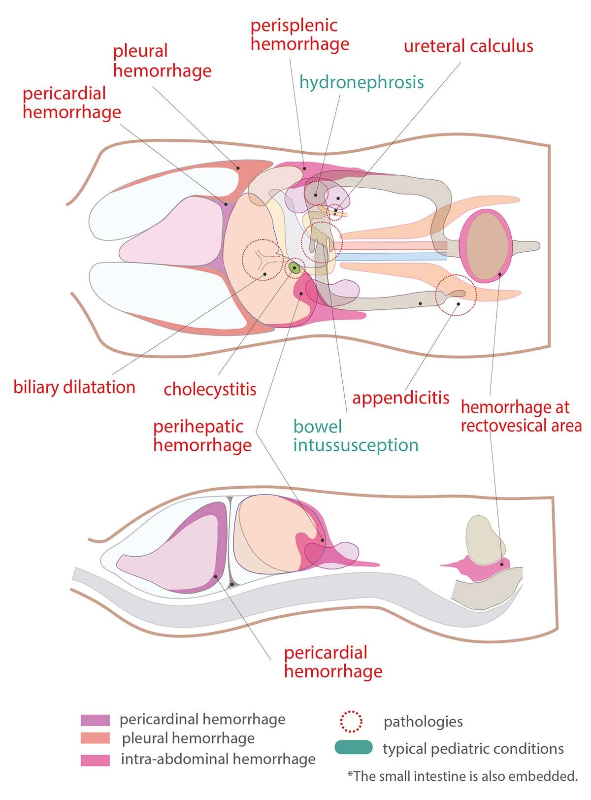 Pädiatrisches FAST Ultraschall - Untersuchungsmodell 1