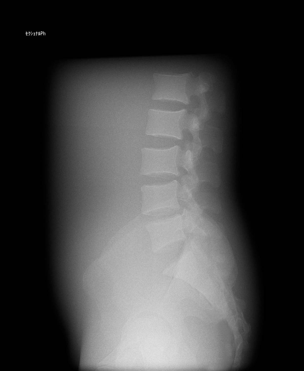 Röntgen-Teilphantom mit künstlichen Knochen - Becken, opak 1