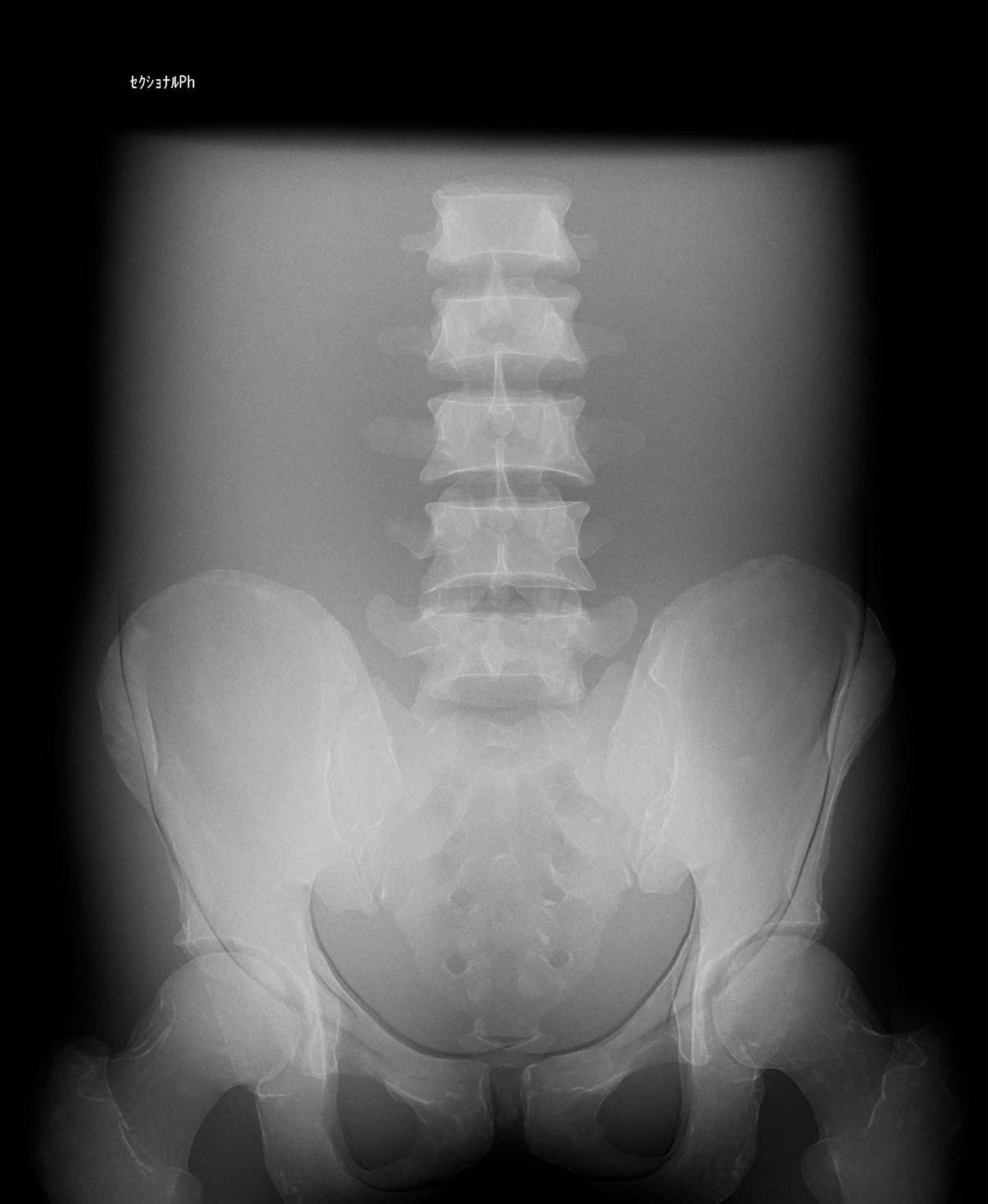 Röntgen-Teilphantom mit künstlichen Knochen - Becken, opak 1