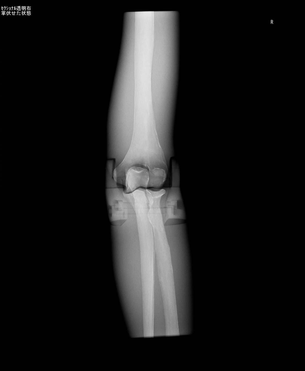 Röntgen-Teilphantom mit künstlichen Knochen - Rechter Ellenbogen, transparent 1