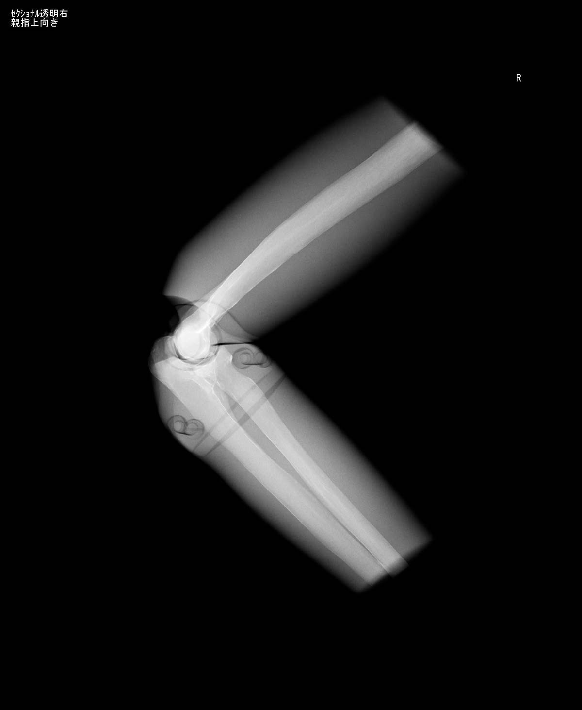 Röntgen-Teilphantom mit künstlichen Knochen - Rechter Ellenbogen, transparent 1