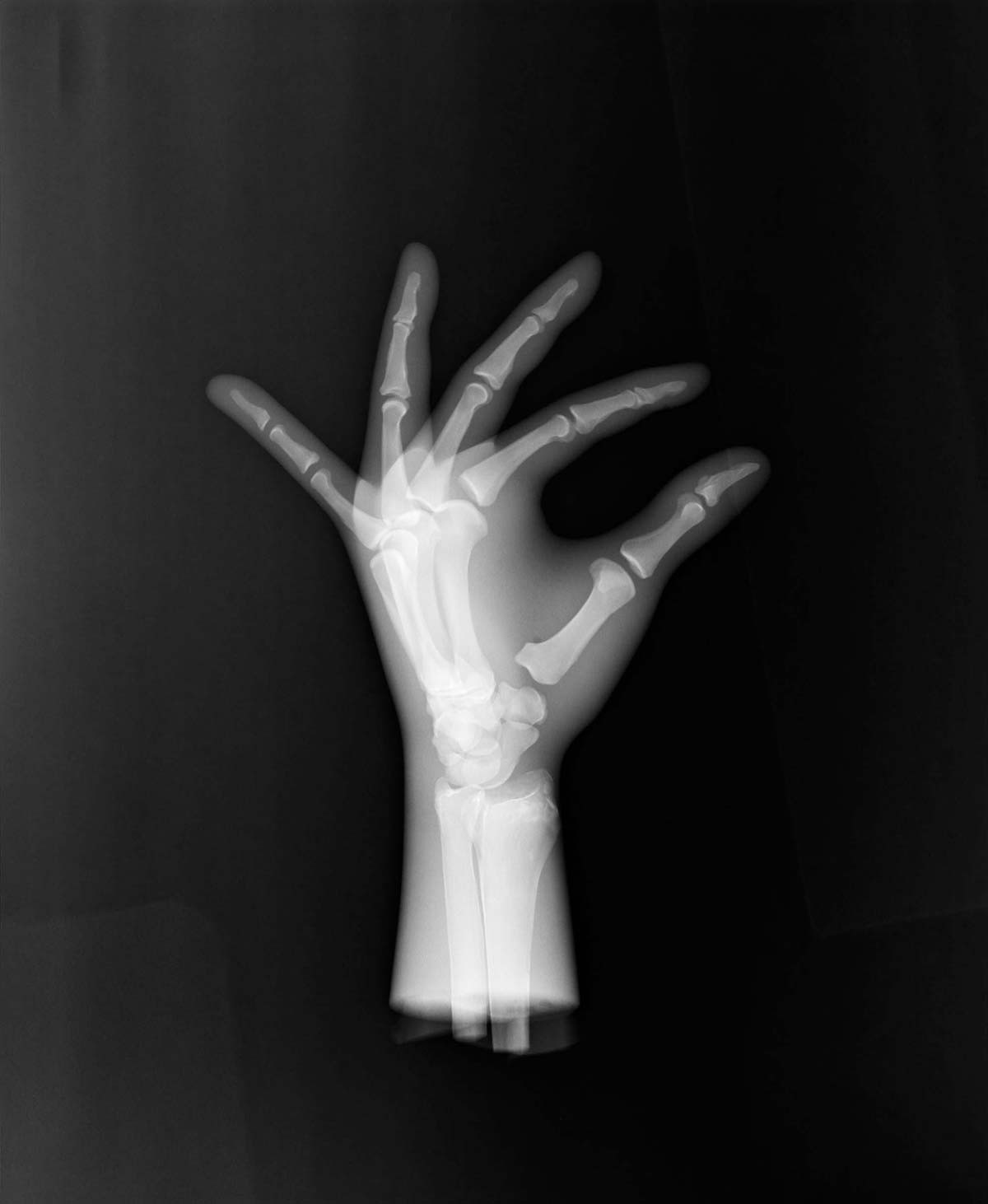 Röntgen-Teilphantom mit künstlichen Knochen - Linke Hand, transparent 1