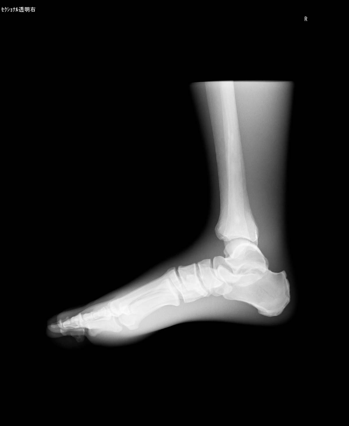 Röntgen-Teilphantom mit künstlichen Knochen - Rechter Fuß, transparent 1
