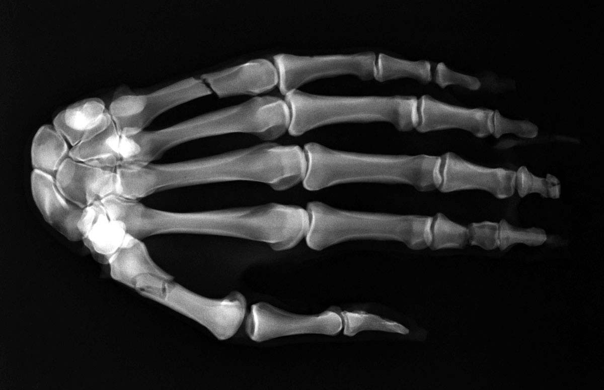 Frakturenhand mit Unterarm für Modulares Ganzkörper Röntgenphantom 1