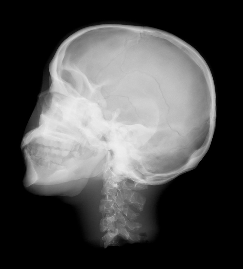 Röntgen-Teilphantom mit künstlichen Knochen - Kopfphantom, transparent 1