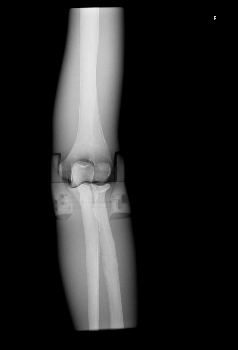 Röntgen-Teilphantom mit künstlichen Knochen - Rechter Ellenbogen, opak 1