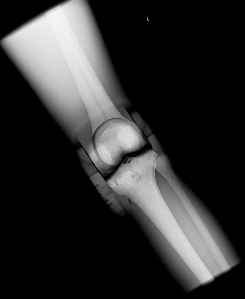 Röntgen-Teilphantom mit künstlichen Knochen - Rechtes Knie, opak 2