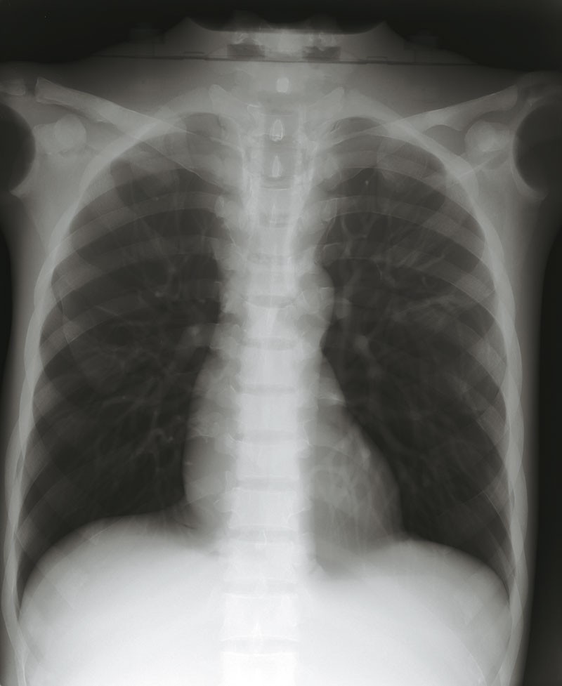 Modulares Ganzkörper Röntgenphantom 