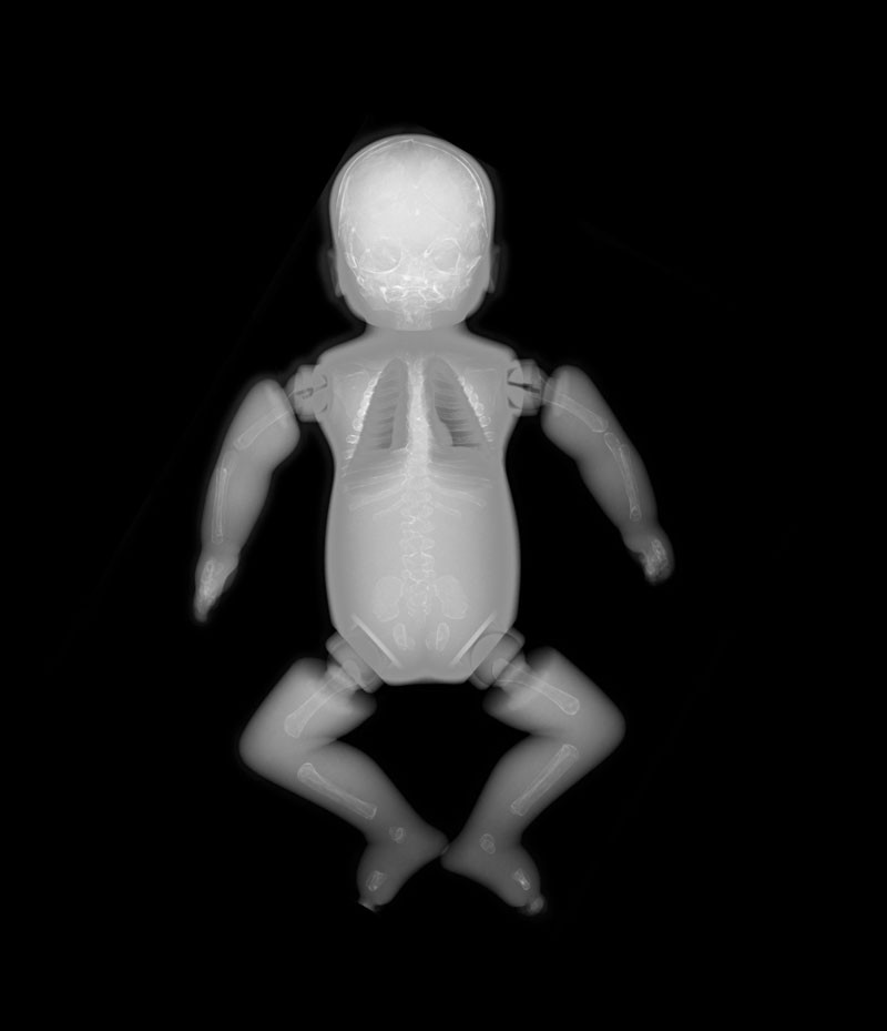 Neugeborenen Ganzkörper Röntgenphantom 