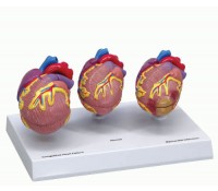 Herzerkrankungs-Modell