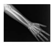Röntgenphantom Unterarm, opak