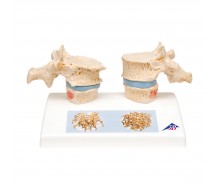 Osteoporose Modell