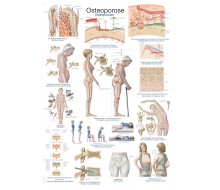 Lehrtafel "Osteoporose" 1