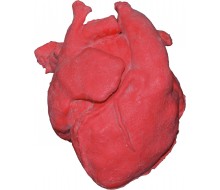Pädiatrisches Herz mit korrigierter Transposition der großen Arterien (TGA) und Ventrikelseptumdef 1
