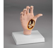 Osteoarthritis (OA) Hand 1