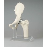 Modell Hüftgelenk mit Schalenprothese