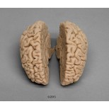 Menschliches Gehirn, Naturabguss 1