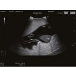 Ultraschalluntersuchungsphantom-Fötus 6