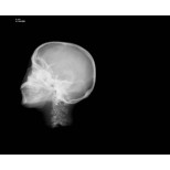 Röntgen-Teilphantom mit künstlichen Knochen - Kopfphantom, opak 2