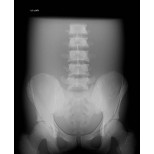 Röntgen-Teilphantom mit künstlichen Knochen - Becken, opak 2