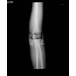 Röntgen-Teilphantom mit künstlichen Knochen - Rechter Ellenbogen, transparent 4
