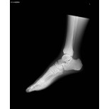 Röntgen-Teilphantom mit künstlichen Knochen - Linker Fuß, transparent
