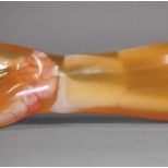 Frakturenhand mit Unterarm für Modulares Ganzkörper Röntgenphantom 5