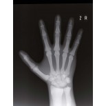 Frakturenhand mit Unterarm für Modulares Ganzkörper Röntgenphantom 6