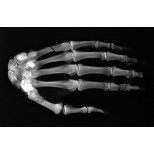 Frakturenhand mit Unterarm für Modulares Ganzkörper Röntgenphantom 3