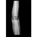 Röntgen-Teilphantom mit künstlichen Knochen - Rechter Ellenbogen, opak 2