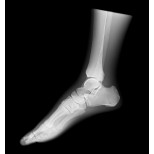Röntgen-Teilphantom mit künstlichen Knochen - Linker Fuß, opak 1